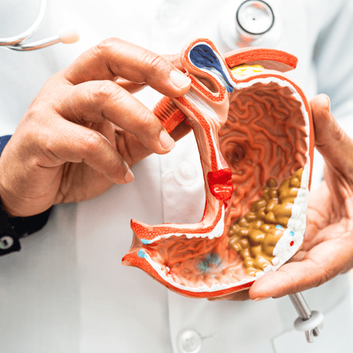 Stage 4 Colon Cancer Treatment in Mexico